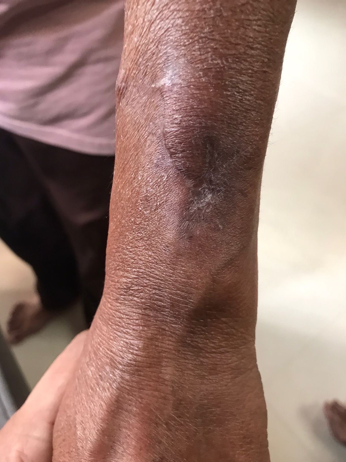 Chronic Wound Healing - After treatment